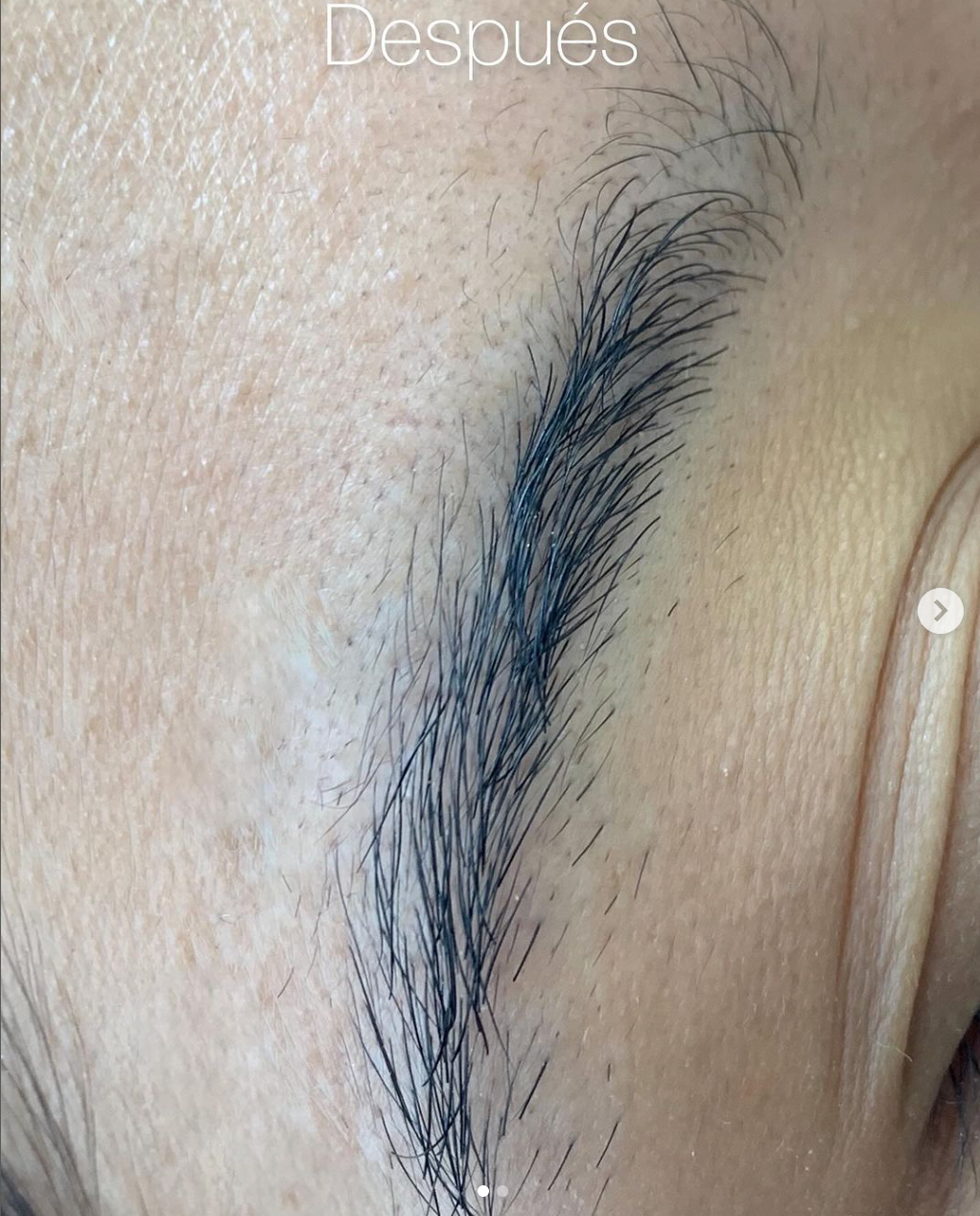 Cejas después del procedimiento de remoción de micropigmentación